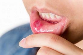 lower-lip-with-canker-sore.jpg