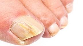 photo-of-toenail-fungus.jpg