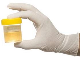 hand-with-glove-holding-sample-of-urine.jpg