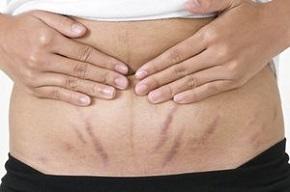 holding-stomach-with-stretch-marks.jpg