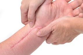 photo-of-wrist-with-scars.jpg