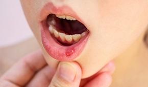 woman-with-canker-sore.jpg