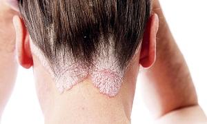 photo-of-scalp-ringworm.jpg