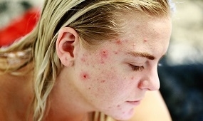 Photo of Woman with Acne